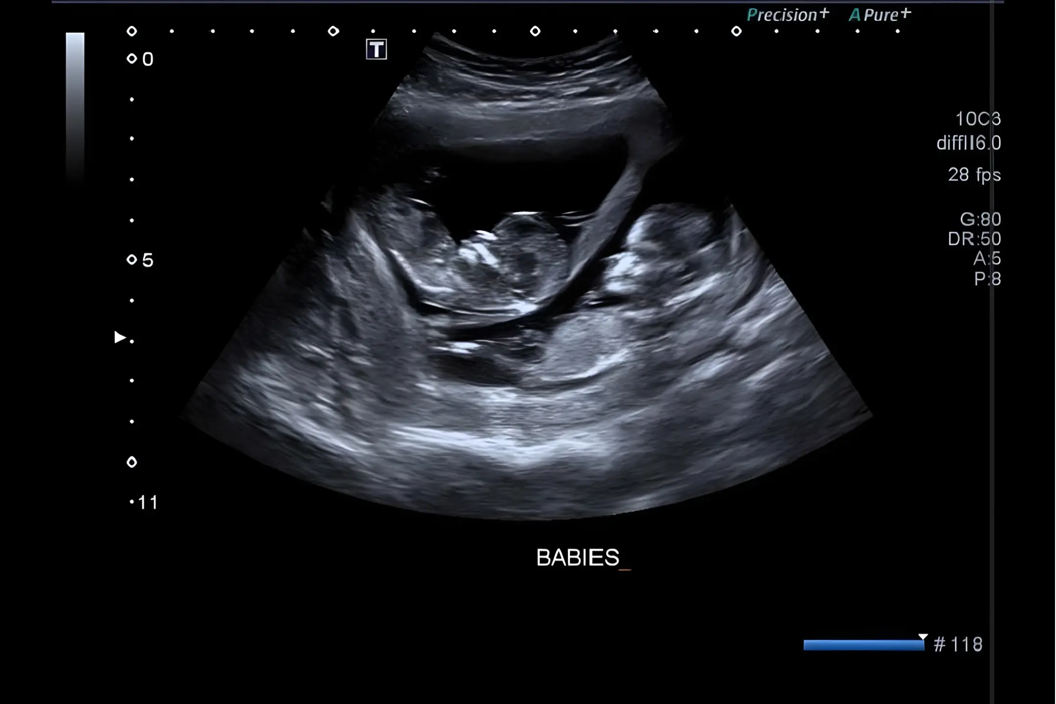 Expecting twins